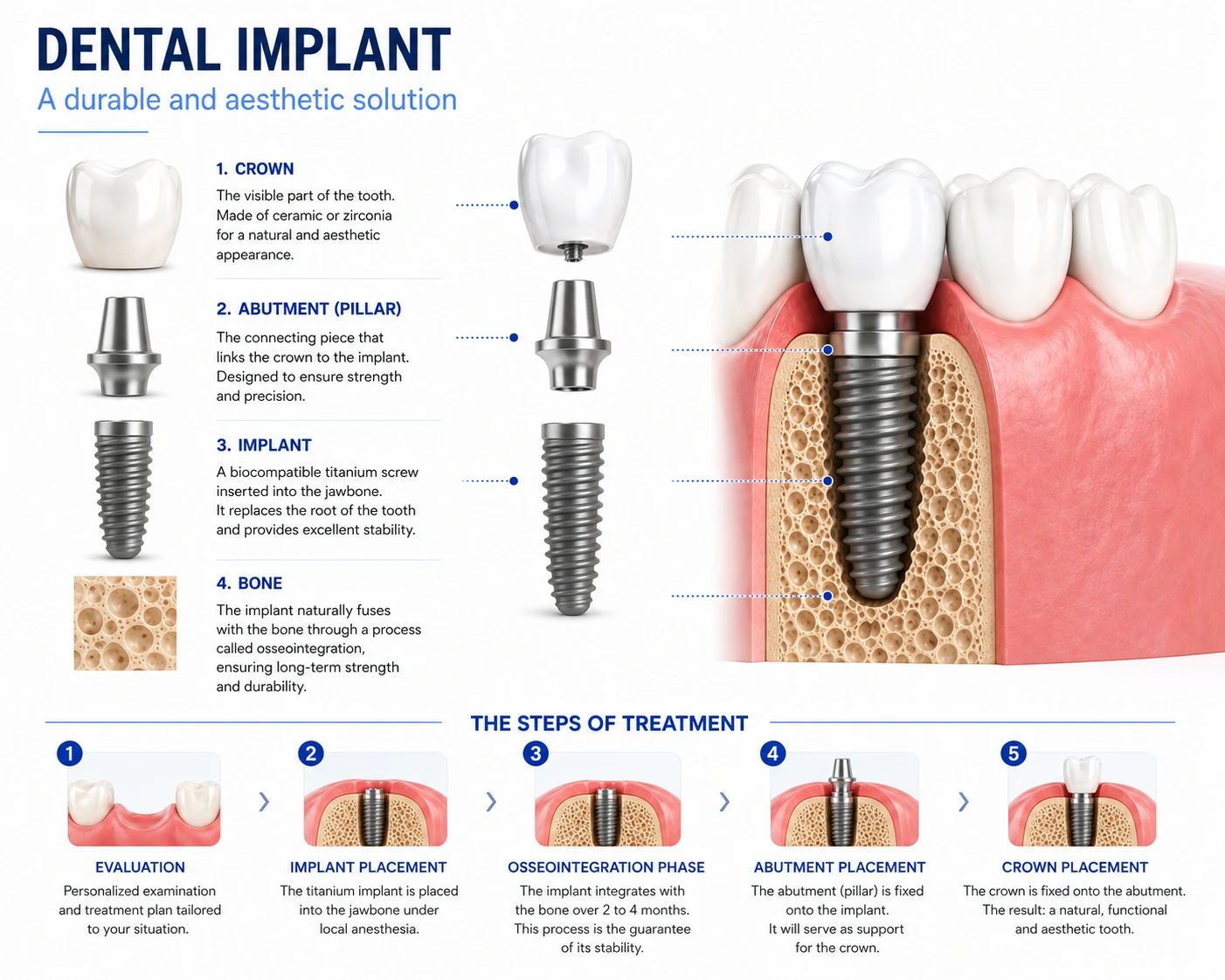 Dental implants