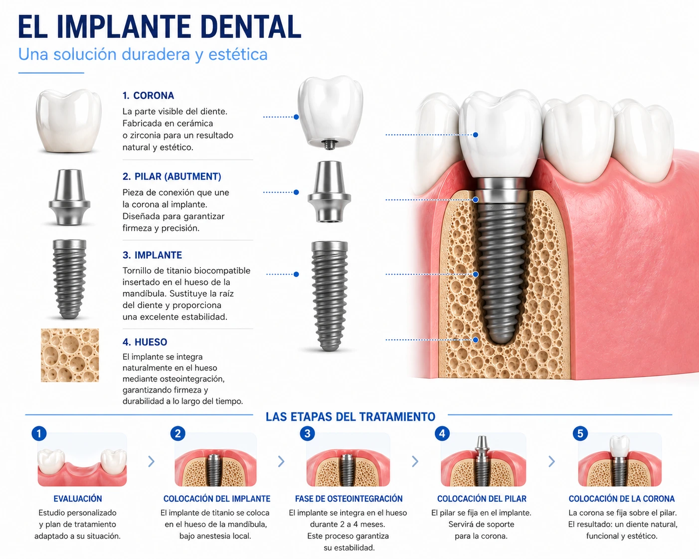 Implantes dentales