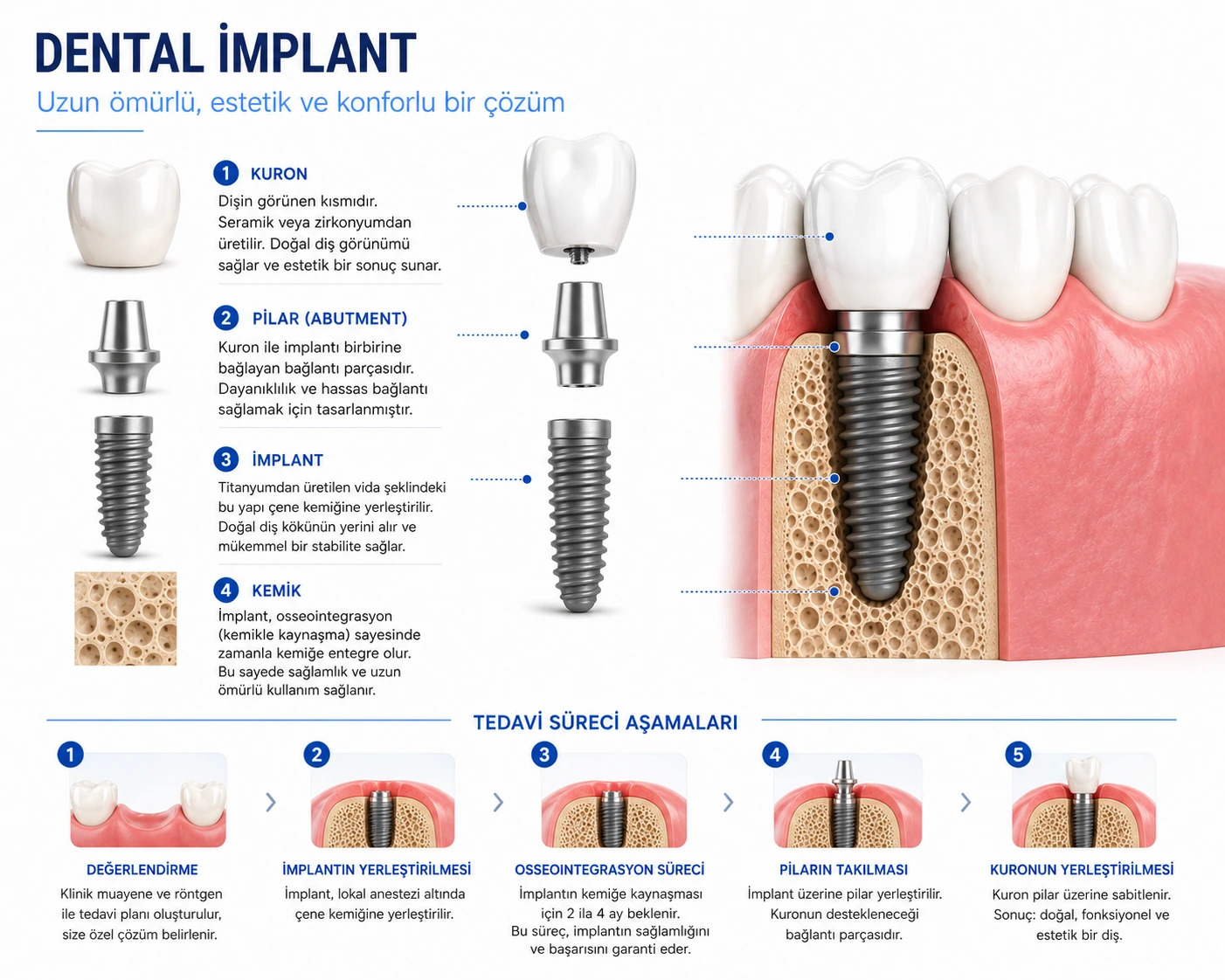 Diş implantları