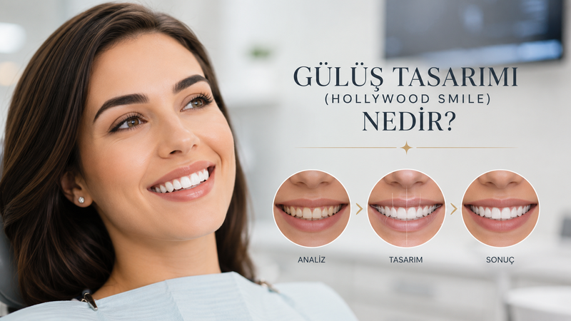 Conception du sourire / Hollywood Smile : en quoi consiste le projet ?